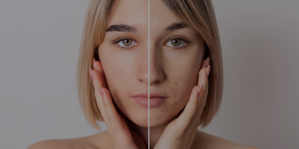 ¿Cómo tener una piel lisa y sin imperfecciones? Consejos y cuidados para el acné